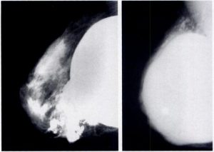 medical mammogram images showing two different breast scans