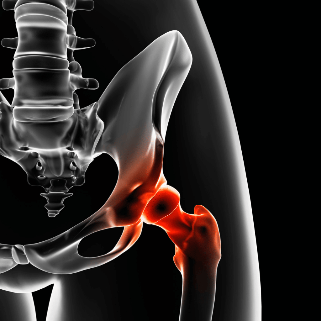digital medical illustration highlighting a hip joint with inflamed areas in red