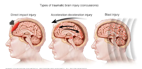 Illustration of different types of traumatic brain injuries including direct impact injury, acceleration-deceleration injury, and blast injury.